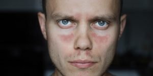 Lupus: causas, síntomas y tratamiento