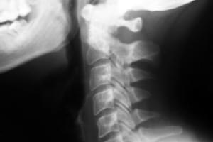 Radiografía. Una proyección de columna cervical en Sabadell