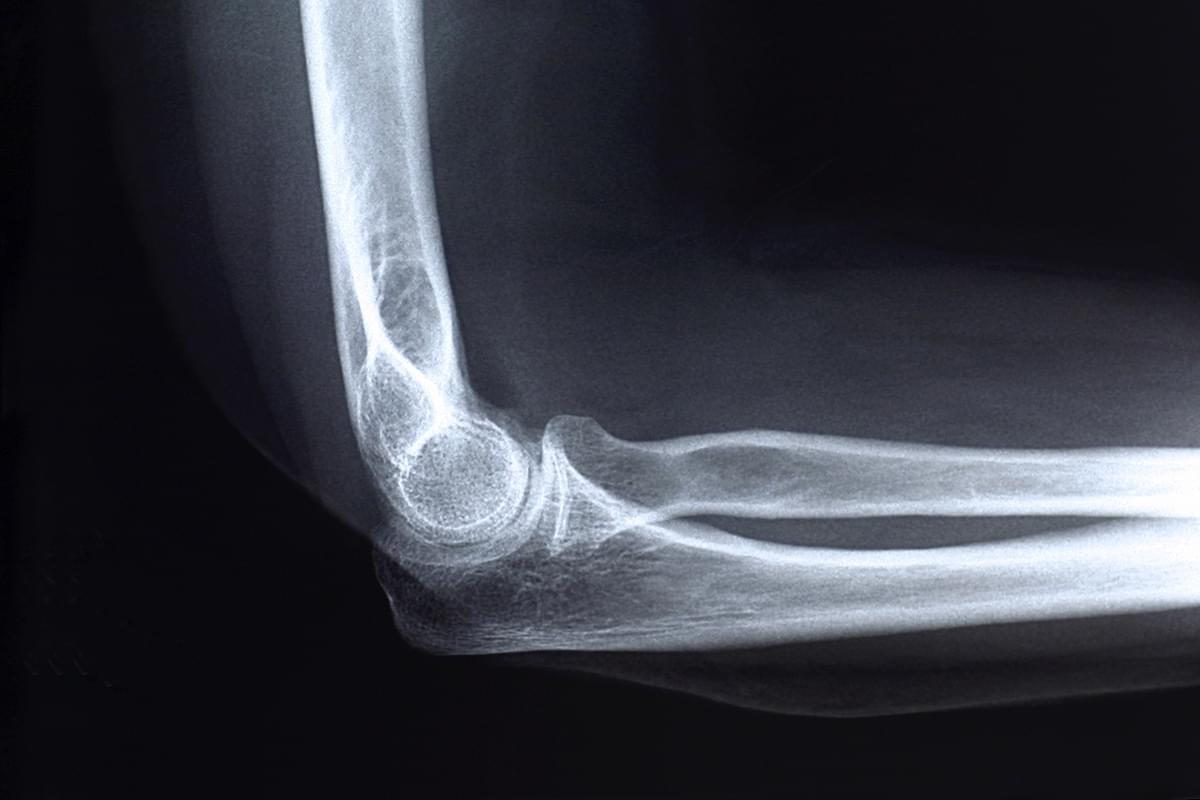 Radiografía. Una proyección de brazo (húmero) o antebrazo (cúbito y radio) en Sabadell