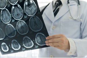 Consulta de Neurología en Barcelona