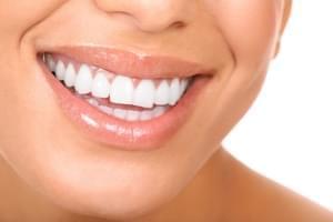 Blanqueamiento dental en Madrid